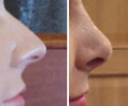 Rhinoplasty