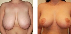 Breast reduction