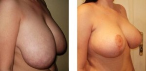 Breast reduction