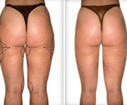 Liposuction