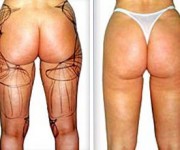 Liposuction