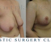 Breast Reduction - After 2 months