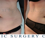 Liposuction - before and after pictures