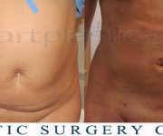 Abdominal liposuction - 1 day after surgery - Beauty Group - Artplastica