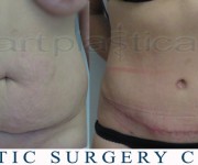 Tummy Tuck - After 2 months