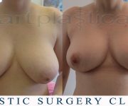 Breast Reduction 