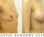 Breast enlargement - photo before and after surgery - Beauty Group