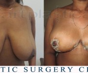 Breast reduction