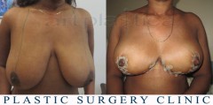 Breast reduction - before and after surgery