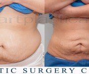 liposuction - Beauty Group - Artplastica