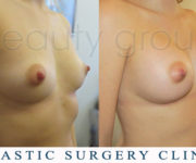 Breast enlargement - photo before and after surgery - Beauty Group