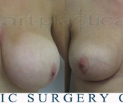 Breast reduction