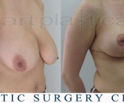 Breast Reduction