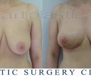 Breast reduction 3 weeks after operation