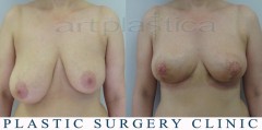 Breast reduction - before and 3 weeks after surgery