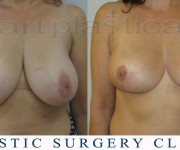 Breast Reduction