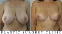 Breast reduction - before and after surgery