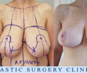 Breast Reduction - 2 months after surgery - Beauty Group