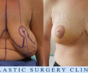 Breast Reduction - Beauty Group