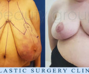 Breast Reduction - Beauty Group