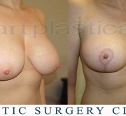 Breast uplift - mastopexy (2 months after)