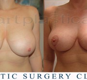 Breast uplift - mastopexy (2 months after)