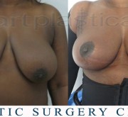 Breast uplift - mastopexy