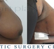 Breast uplift - mastopexy