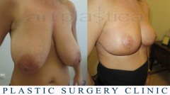 Breast reduction - before and after surgery