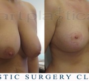 Breast uplift - mastopexy