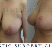 Breast uplift - mastopexy