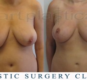 Breast uplift - mastopexy