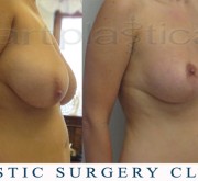 Breast uplift - mastopexy