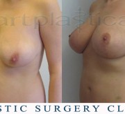 Breast uplift - mastopexy