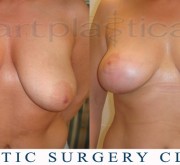 Breast uplift - mastopexy