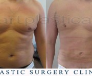 Liposuction - before and after pictures