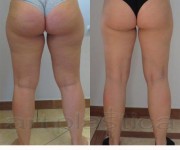 Liposuction - before and after pictures