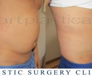 Beauty Group -Artplastica - liposuction before, after