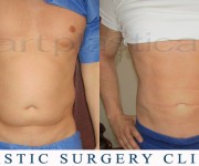 Beauty Group -Artplastica - liposuction before, after