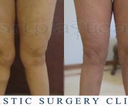 Liposuction knees - Artplastica Beauty Group