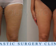 Beauty Group - liposuction before, after