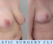 Breast Reduction - 2 months after surgery - Beauty Group