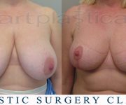 Breast reduction -6 weeks after surgery