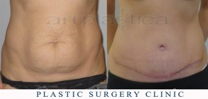 Abdominoplasty (Tummy Tuck) - before and after pictures