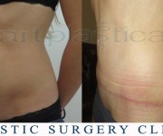 Abdominoplasty (Tummy Tuck) - before and after pictures