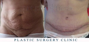 Abdominoplasty (Tummy Tuck) - before and 2 weeks after
