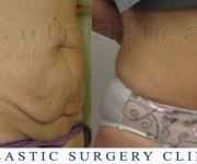 Abdominoplasty (Tummy Tuck) - before and after pictures
