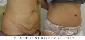 Abdominoplasty (Tummy Tuck) - before and after pictures