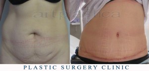 Abdominoplasty (Tummy Tuck) - before and after pictures