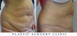 Abdominoplasty (Tummy Tuck) - before and after pictures